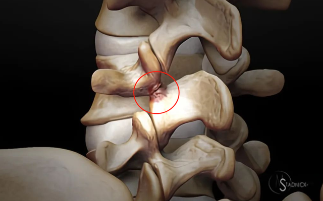 腰椎出现峡部裂
