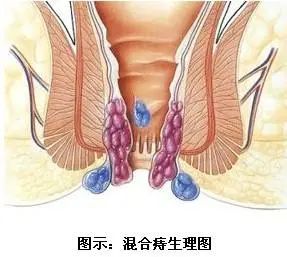 王業皇:坐著屁股疼是怎麼回事?這7種肛腸疾病會導致肛門疼