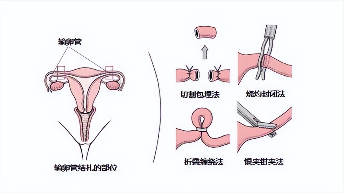 丈夫做结扎手术一年后妻子又怀孕丈夫暴怒,妻子:不怪我