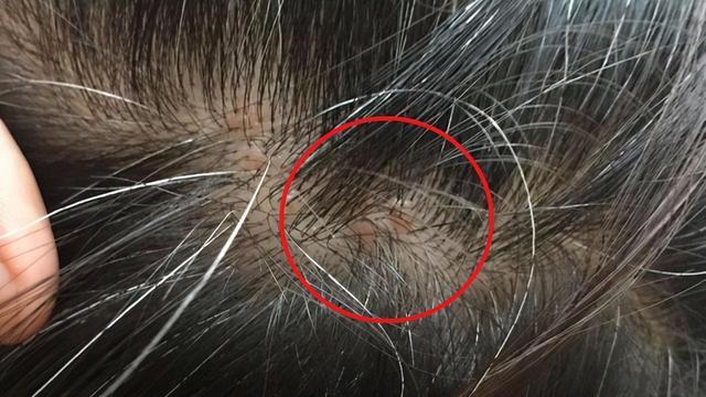 头皮总是长"疙瘩"和"脓包,是啥情况?或许是这4方面的原因