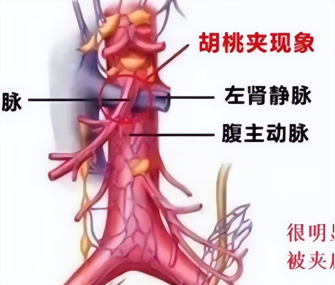 女性胡桃夹现象图片