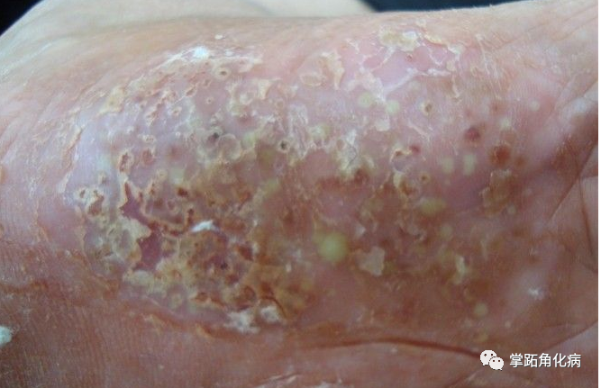 掌跖角化病通常情况下并不会产生瘙痒症状