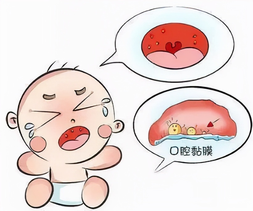 疱疹性咽炎,病原体主要为柯萨奇a组病毒,好发于儿童及青少年