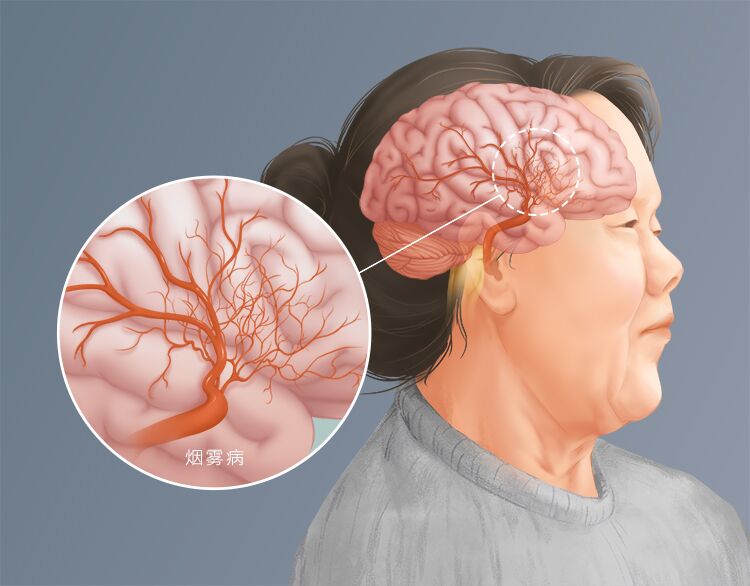 烟雾病,一种女生患病率高的疾病,提前认识烟雾病,做好预防