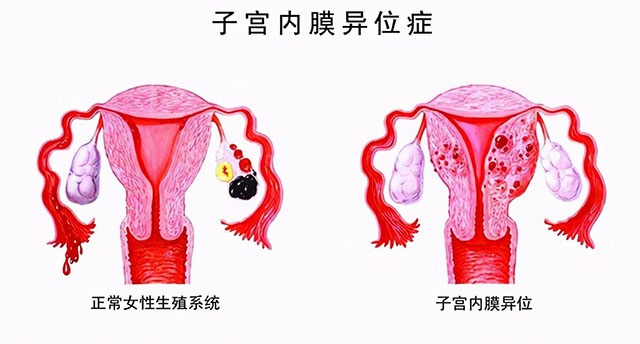 病理性缩复环图片