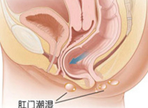 上班久坐"菊花"受不了,怎么办?肛门瘙痒牢记四个小妙招