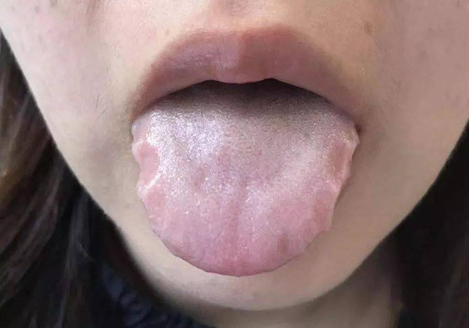 舌边有齿痕出现，常见的原因