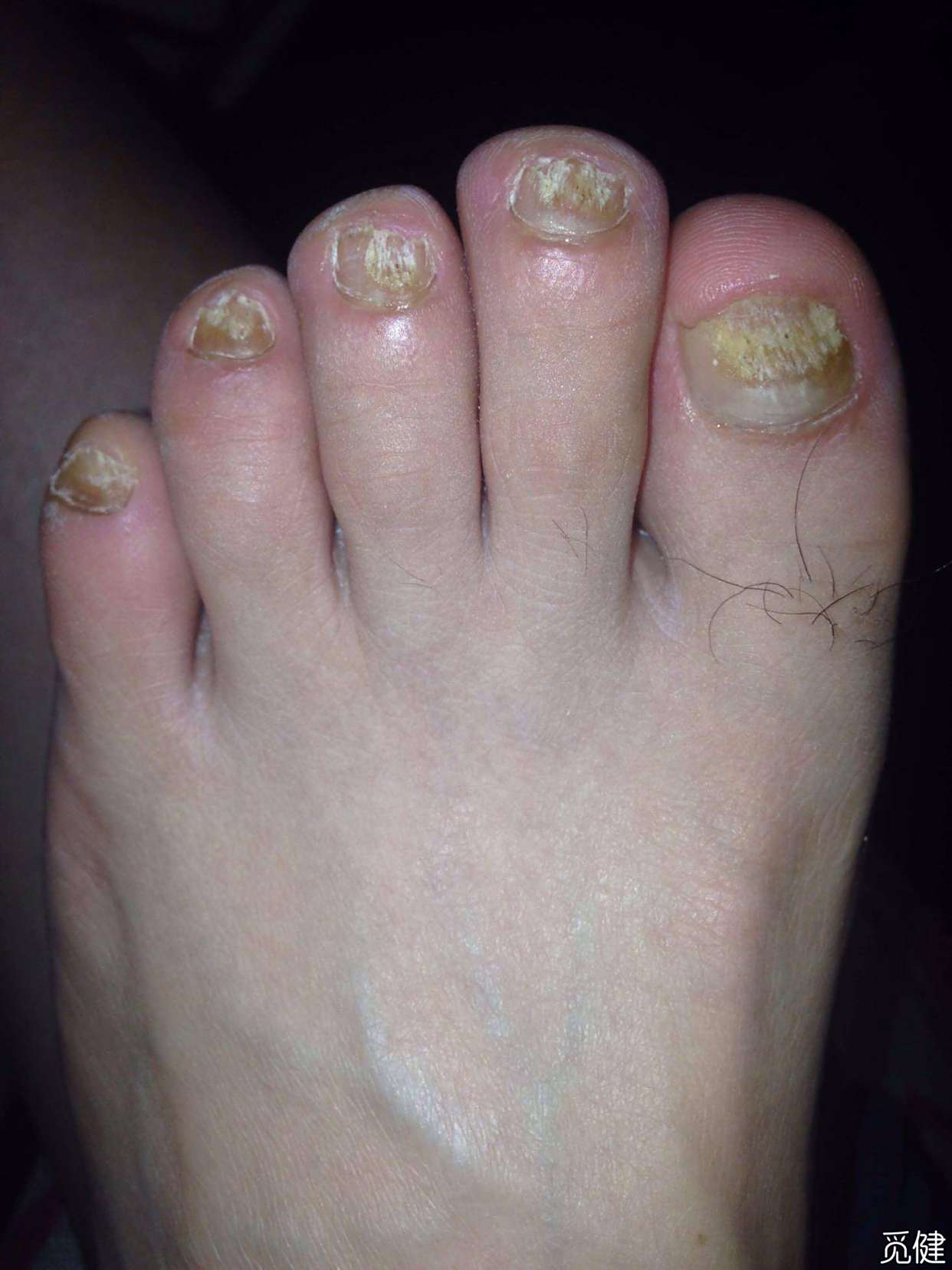 真菌感染的灰指甲最佳治愈方式!醋蒜搭配有奇效?抓紧看!