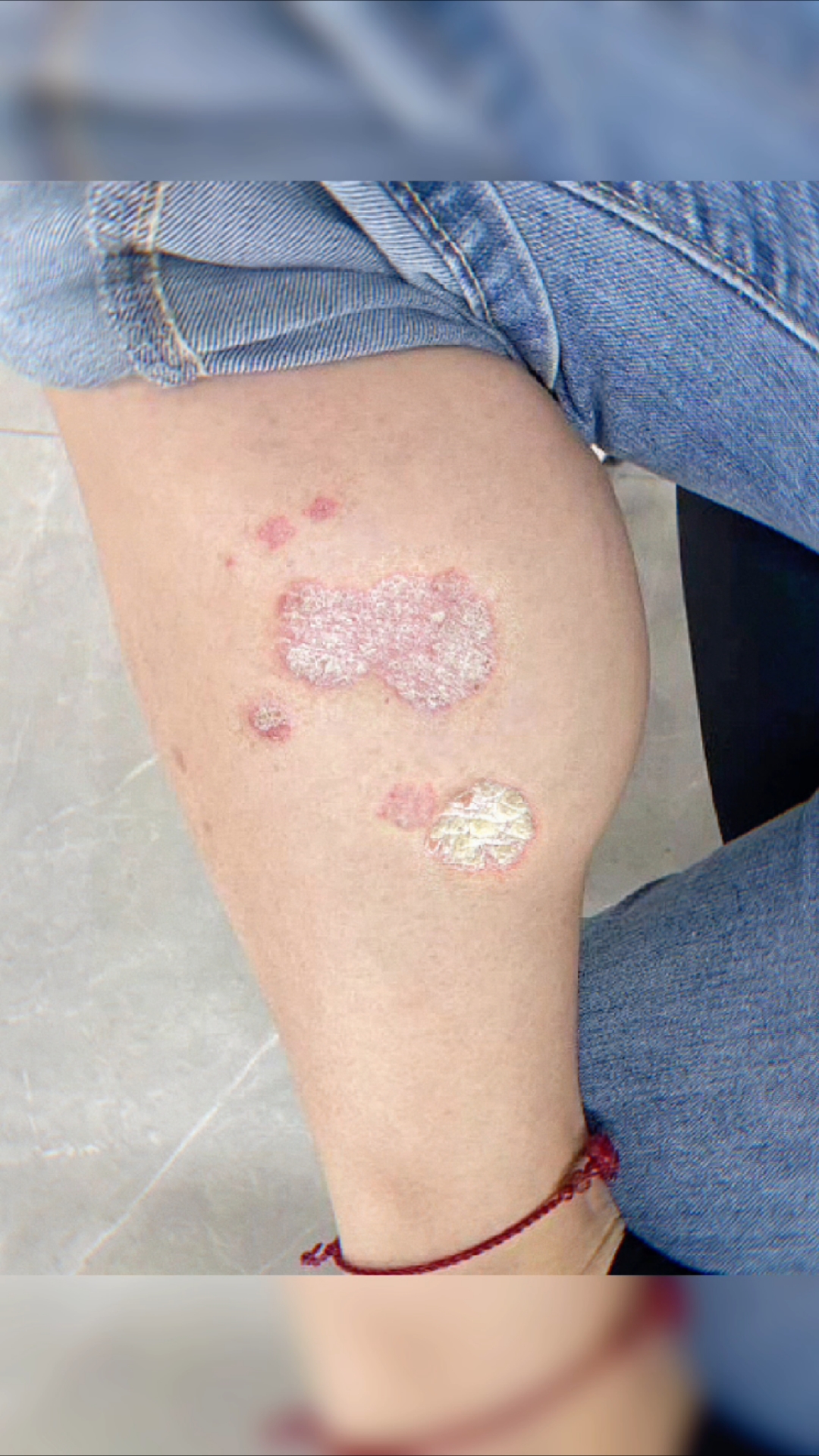 一个多,月,牛皮藓干干净净