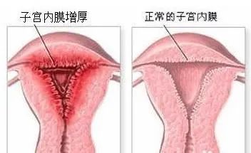 【马博说】内膜那些事儿之子宫内膜增厚