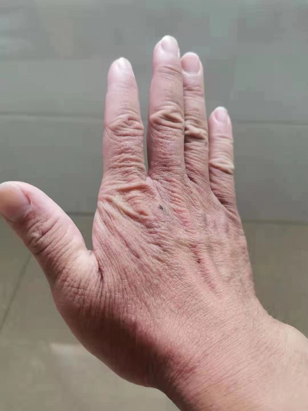 丁虹:手变红变皱像树皮?可能是发生病变了!