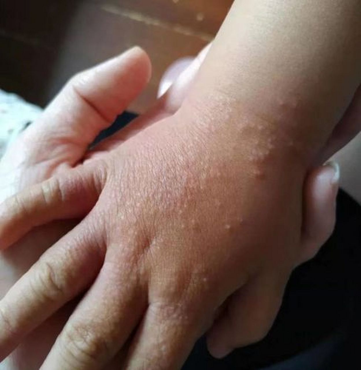 小朋友手背上突然出现一些疙瘩,像米粒一样,而且数量越来越多  这属于