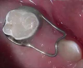 乳牙缺失后需要佩戴间隙保持器?