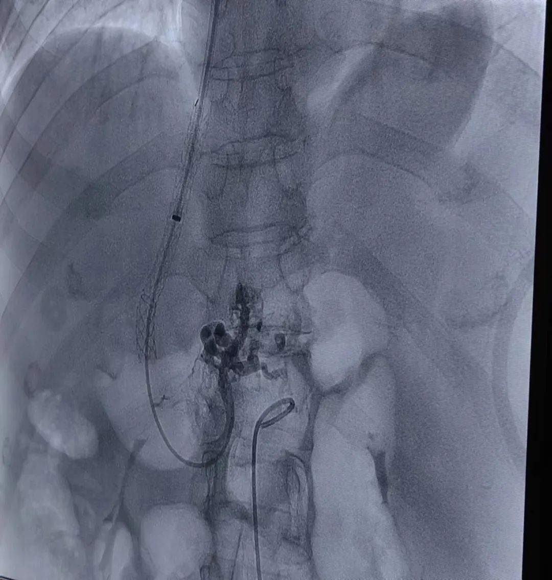 肝脏内置入支架打通生命通道,佛中医成功实施高难度介入术
