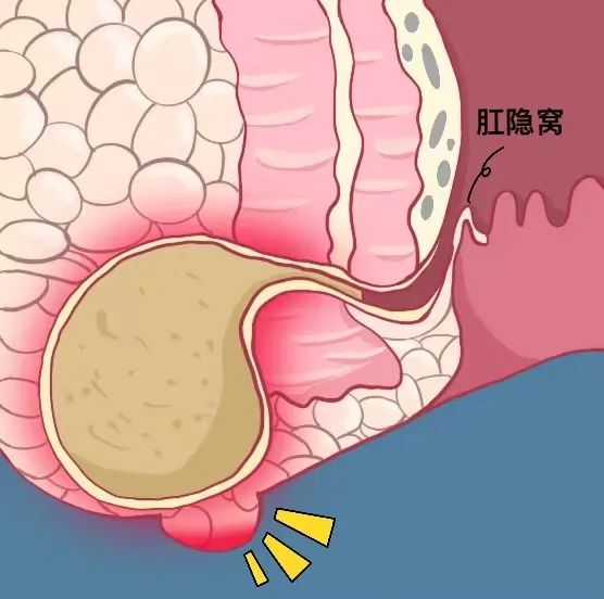 肛周脓肿手术动画演示图片