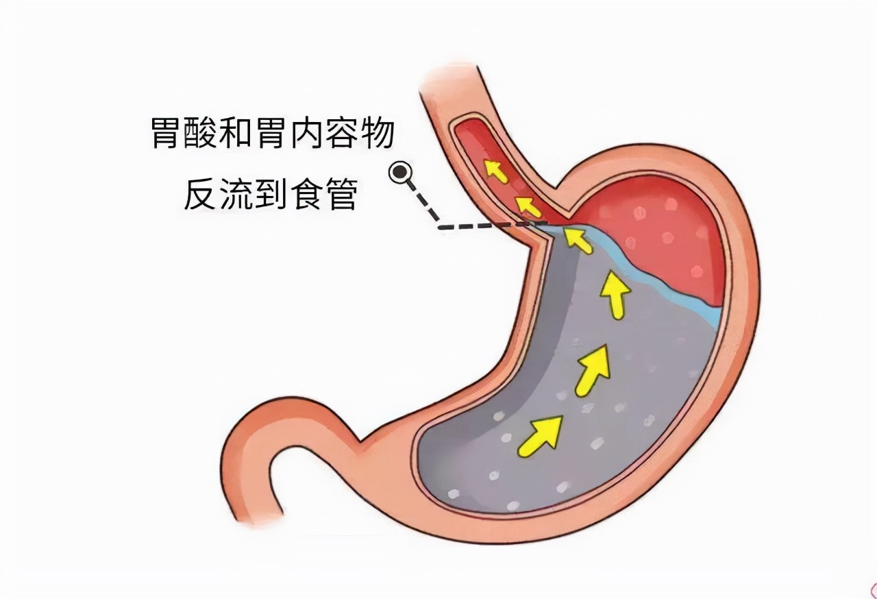 25岁女生一天都在吐苦水,饭后更加严重,胃食管反流有3个特征