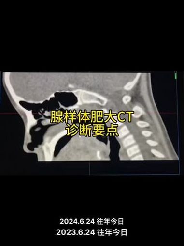 早期作品之腺样体肥大ct诊断标准 腺样体肥大 抖出健康知识宝藏