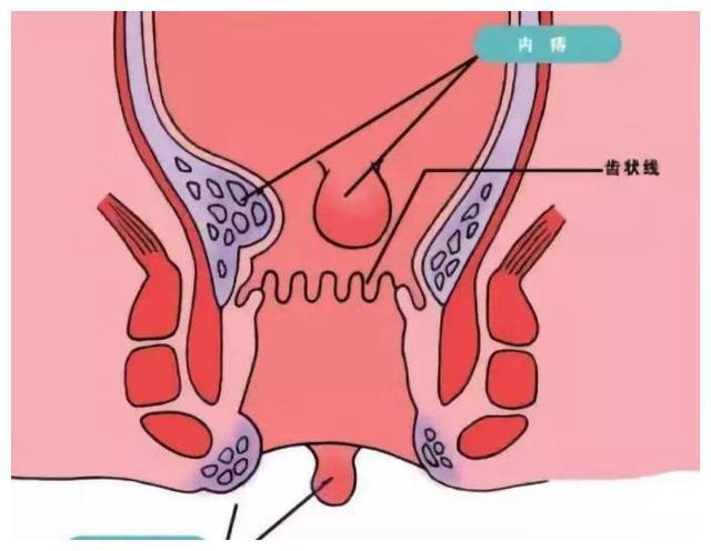 痔疮外痔肉球如何消除?相关部门揭秘最新痔疮特效药!