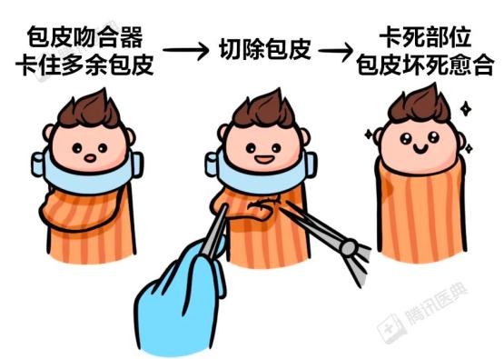 每个男孩都要割包皮吗?