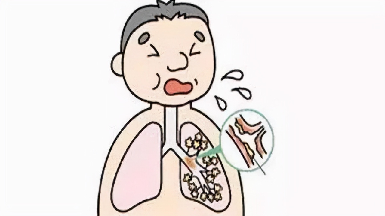 老年人阳性杆菌肺炎,革兰阳性杆菌感染所致,以肺炭疽为主要代表