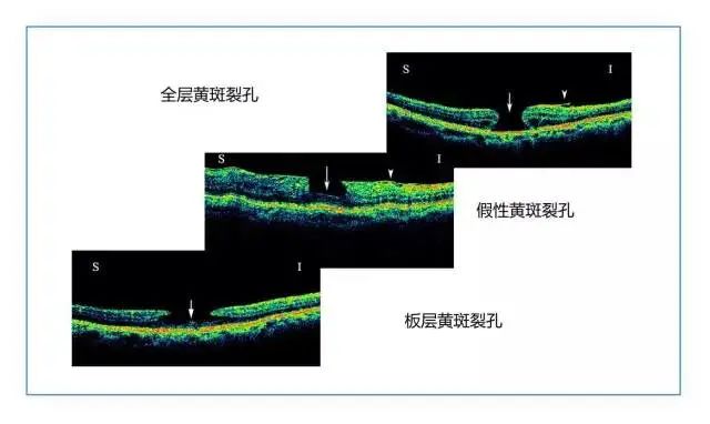 黄斑板层裂孔图片