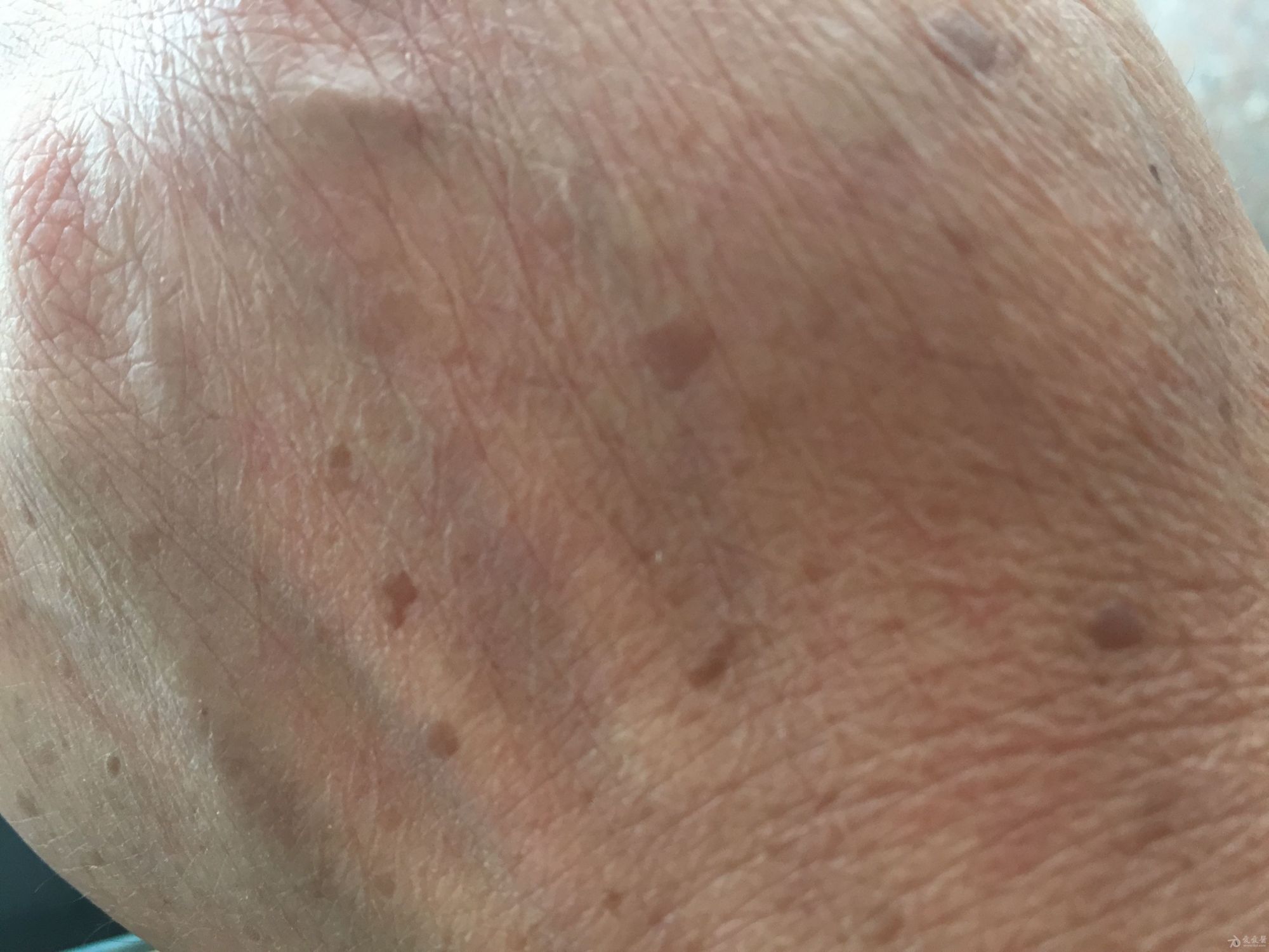 老年斑建议由医生鉴别,无癌变倾向,影响美观的,可选择激光治疗