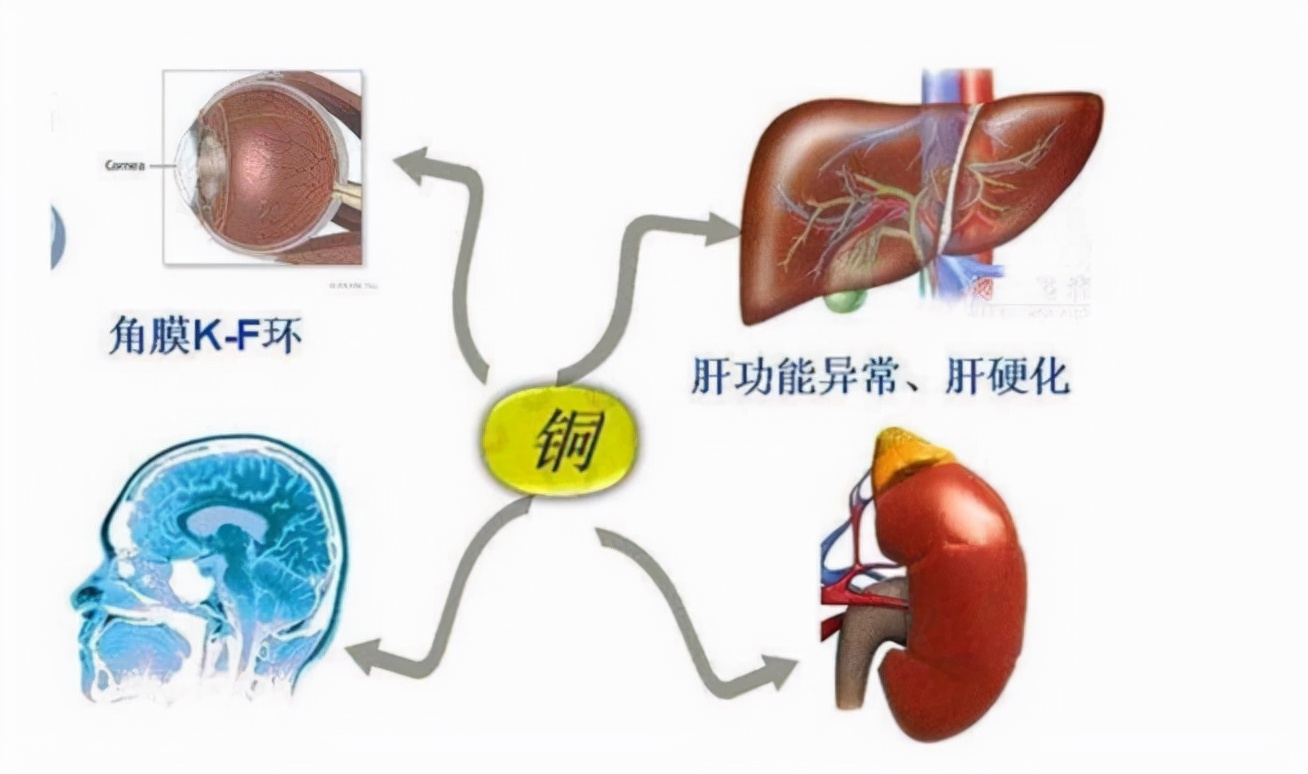肝豆状核变性反复发作,在治疗此类疾病前要对它有一定的了解