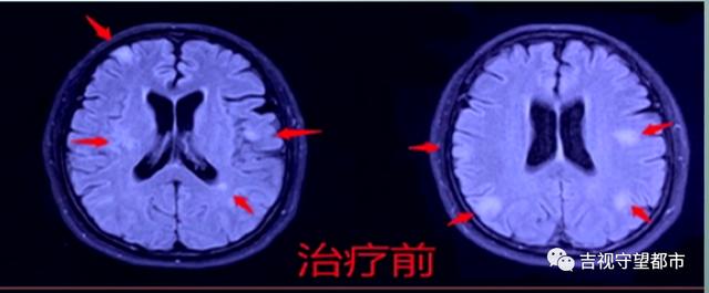 热点|女子一天吃一到两瓶辣酱还自行服胃药，两年半后大脑里“长毛”了
