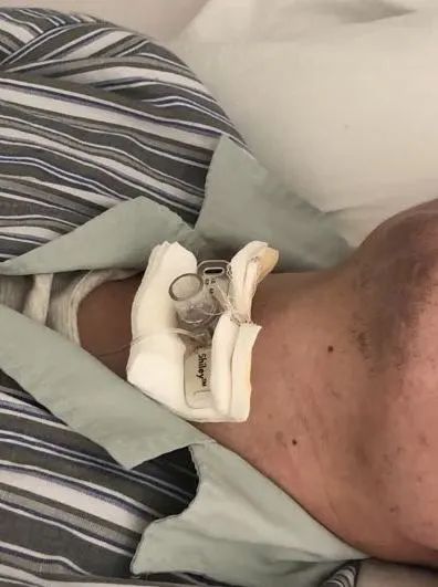 31岁小伙睡觉会昏迷, 气管切开套管成夜间"标配"该如何是好?