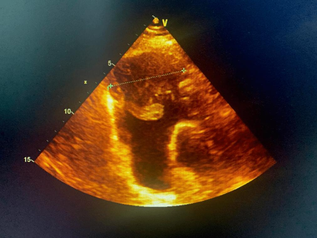 心包间皮瘤常见症状是气促,呼吸困难,胸闷,不具备遗传性