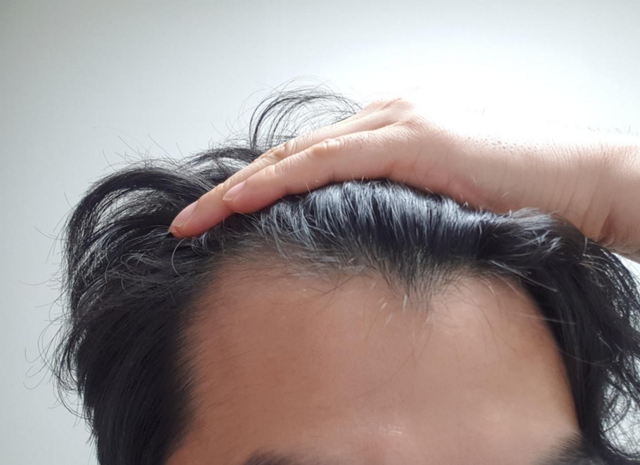 鬓角脱发如何治疗?这个方法修复毛囊,生发不再困难