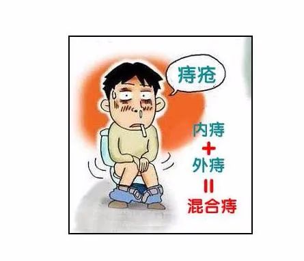 痔瘡手術有哪幾種方法?痔瘡自愈的方法有哪些?