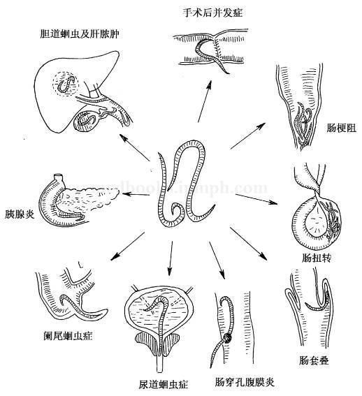 90后都是被蛔虫吓大的吗?以前人人都有蛔虫,为何现在没有了?