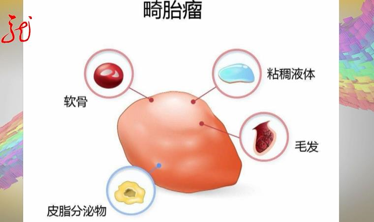 热点|可怕！医生做手术，竟被肿瘤“咬”了手，里面还有头发和牙齿