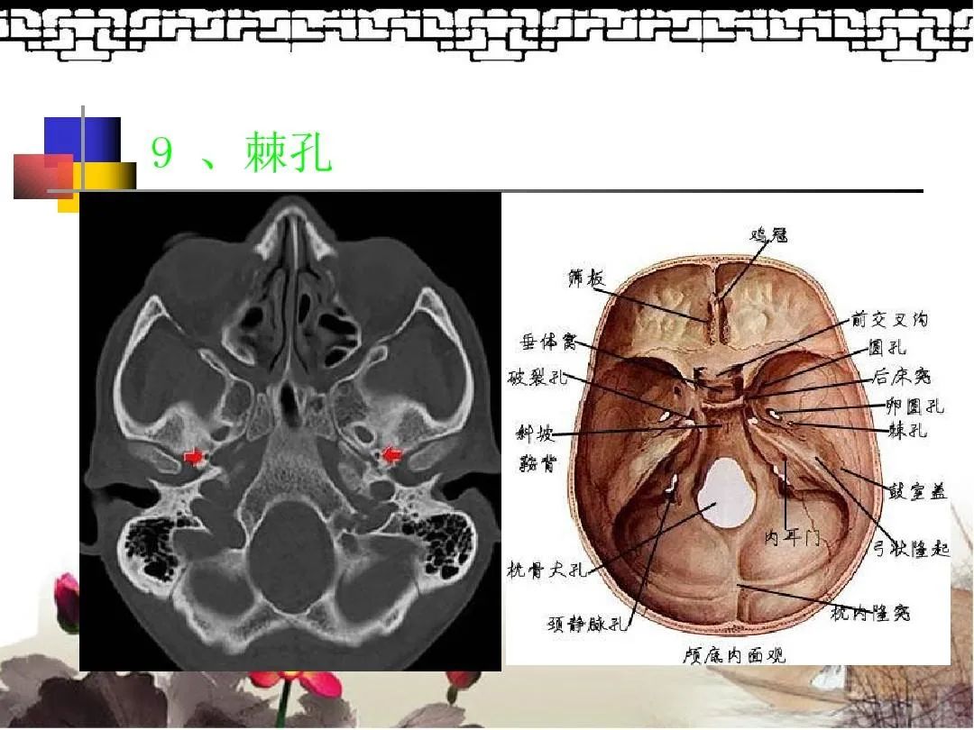 鼻咽部平扫ct解剖图图片