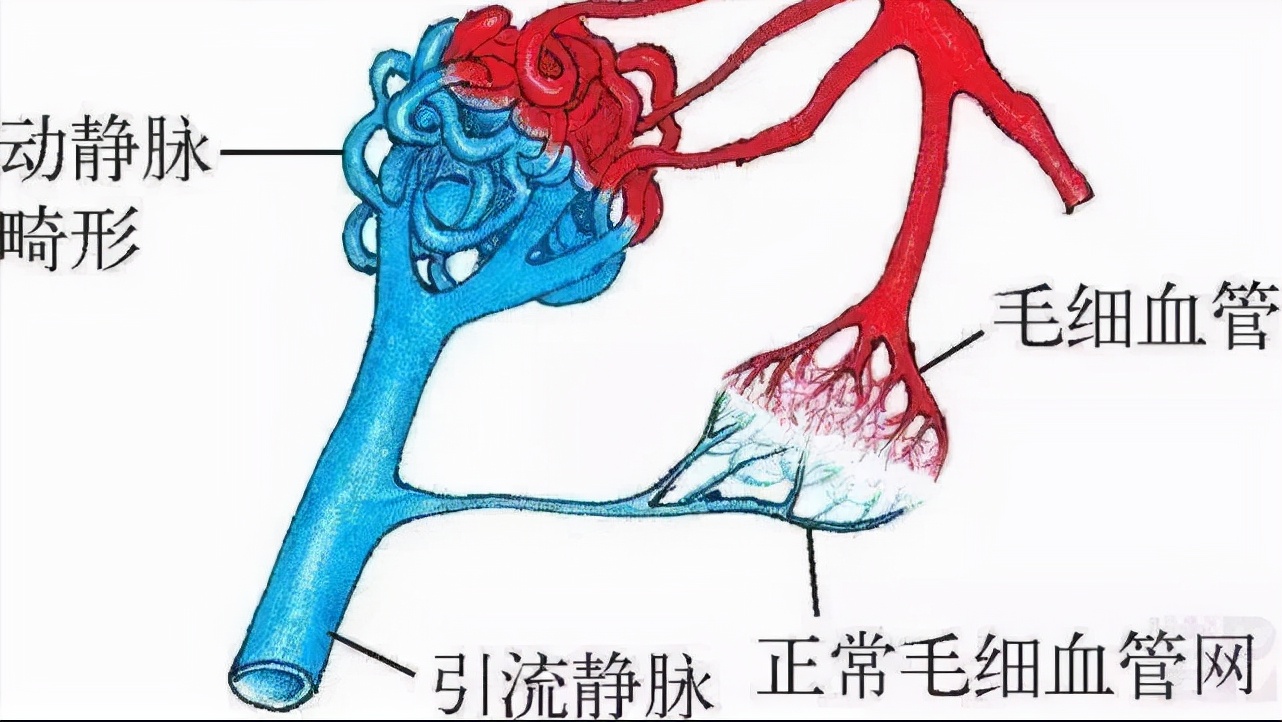 脉管畸形和血管瘤是一种疾病吗,应该如何区分?