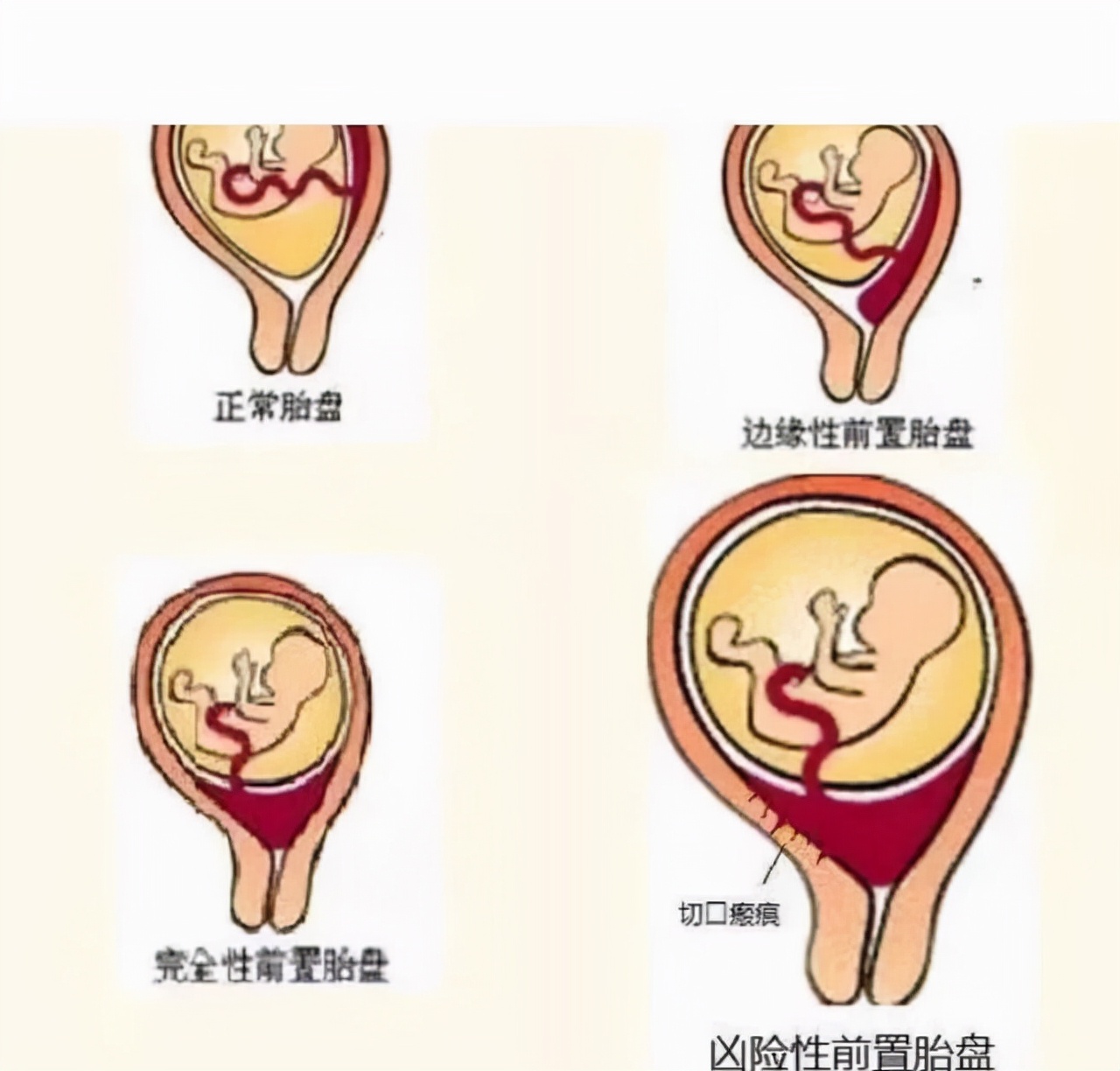 各种胎盘位置图 前壁图片