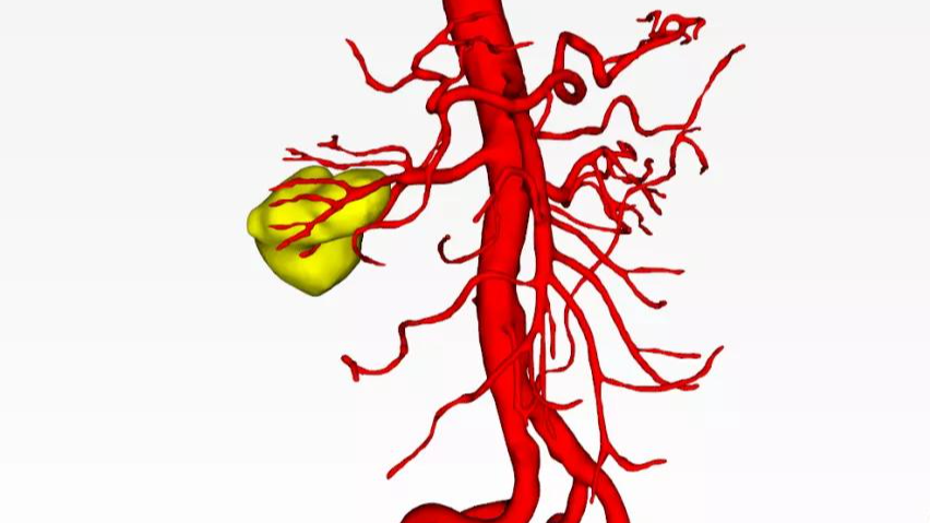 小儿肾静脉血栓形成,常见症状为寒战发热,腹痛,新生儿病死率高