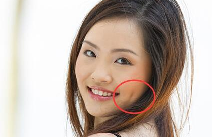 酒窝笑起来是甜美的代表,做酒窝美容需要注意哪些问题