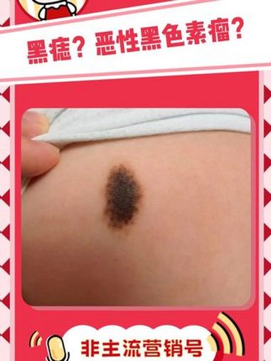痣 医学科普 黑色素瘤 黑色素瘤和黑痣的区别在哪