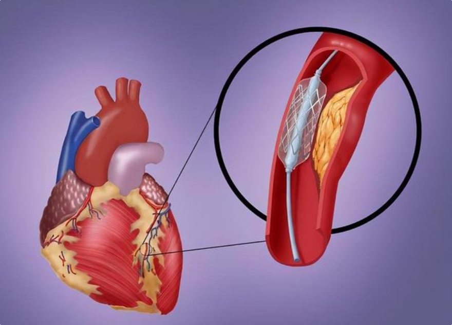 心脏支架图片位置图片