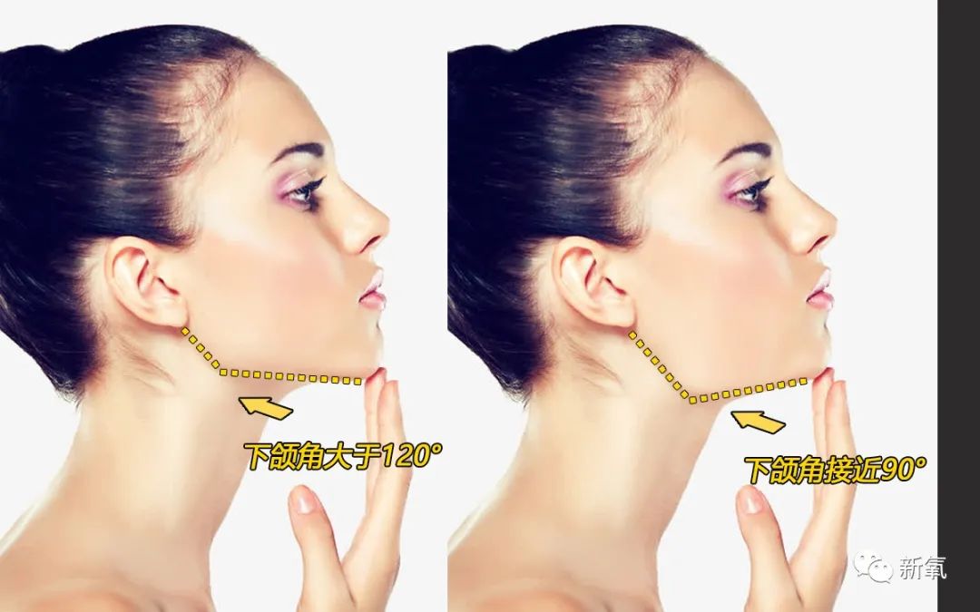 被"切掉"的下颌角,如今又要补回来,方脸不香吗?