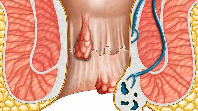 痔疮癌变图片图片