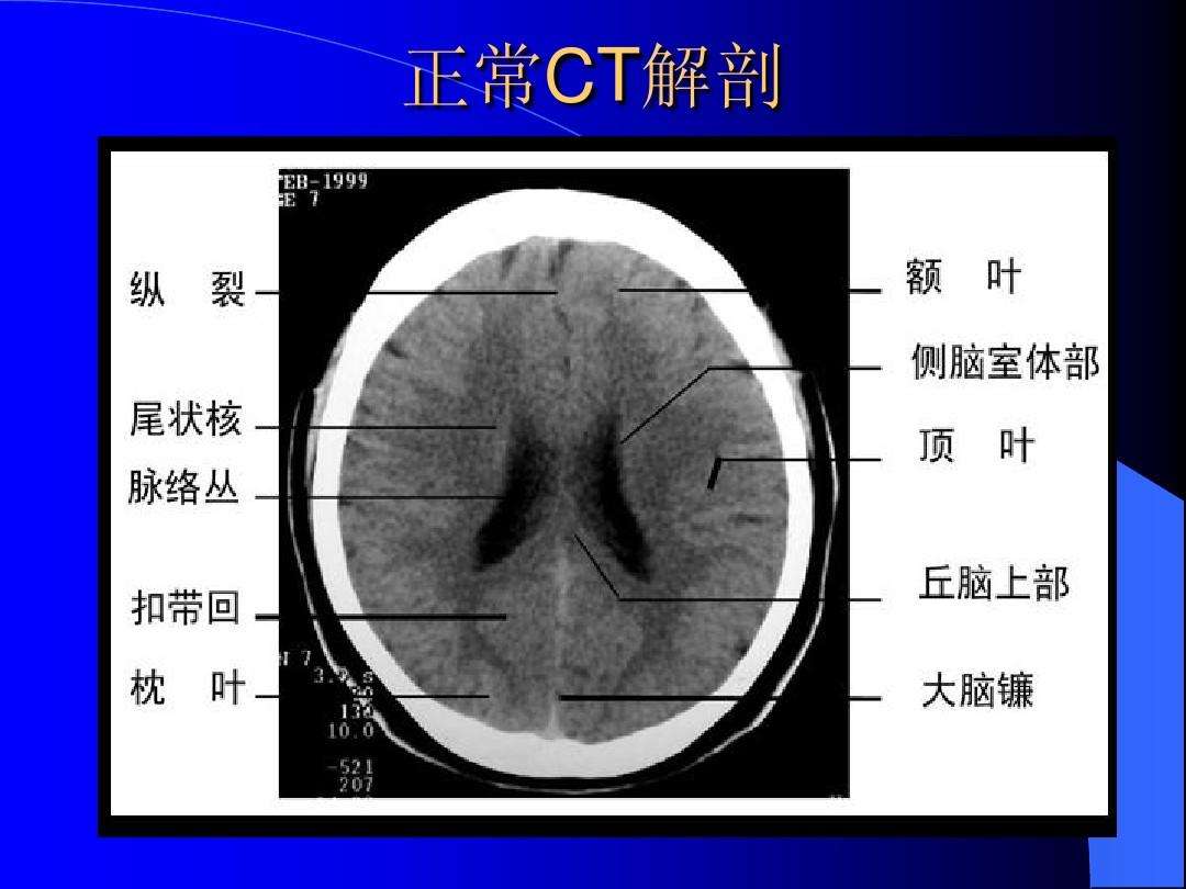 脑部ct结构图片