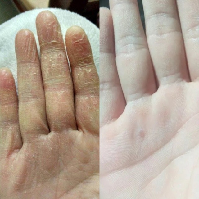 手掌干裂刺痒难忍?跟着过来人坚持这2步,干裂刺痒统统解决!