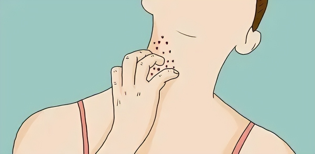 丝状疣应该怎么去除