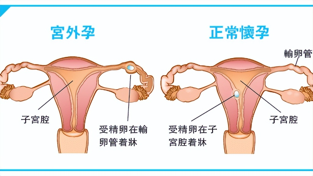 什么叫做宫外孕图片图片