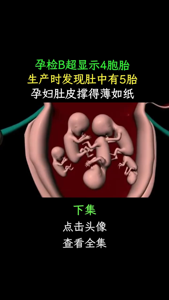 孕检b超显示4胞胎,生产时发现肚中有5胎,孕妇肚皮撑得薄如纸