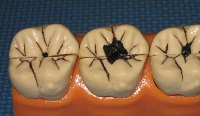 牙菌斑和龋齿的区别