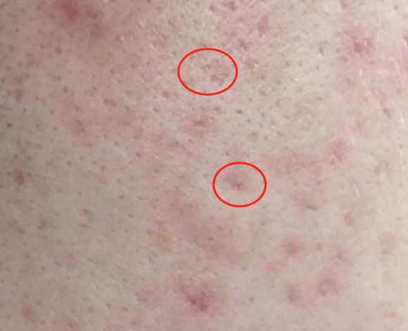 红痘印和黑痘印是怎么来的,有哪些解决痘印的方法?